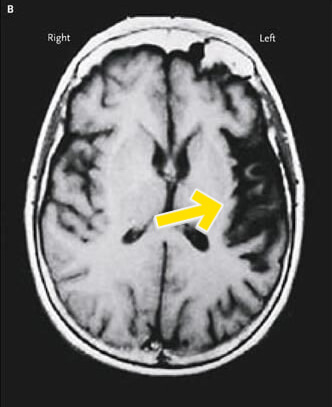 CT scan of brain regions affected by Primary progressive aphasia