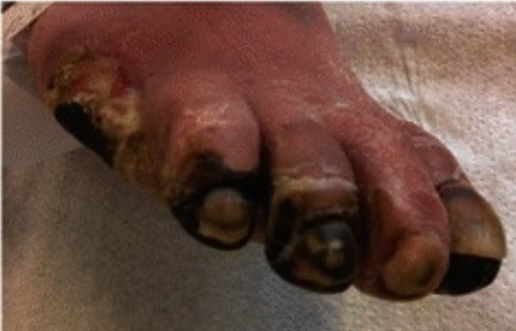 Necrosis Due to PAD