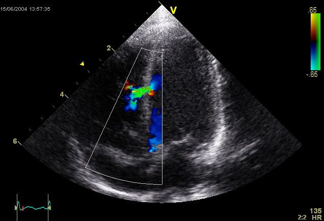 Electrocardiogram