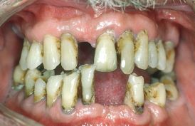 Gum Disease