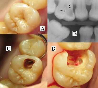 Tooth Decay