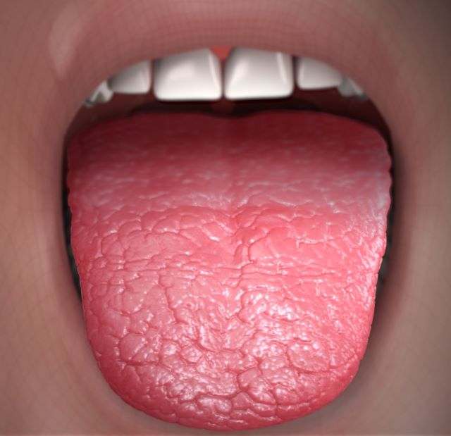 Dry Mouth